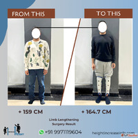 Bone Lengthening Surgery in India - Procedure Cost Recovery ...