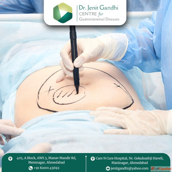 Dr. Jenit Gandhi - Colorectal Surgeon in Ahmedabad for Safe Effective Surgery