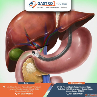 Gastro1 Hospital - Trusted Doctor for ERCP in Ahmedabad for Safe and Effective Treatment