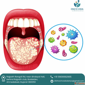 Experienced Oral Cancer Surgeon in Ahmedabad Dr Bhavin Vadodariya