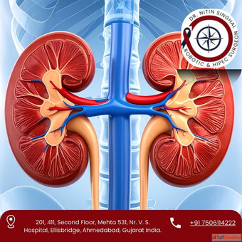 Expert Kidney Cancer Surgeon in Ahmedabad - Dr. Nitin Singhal