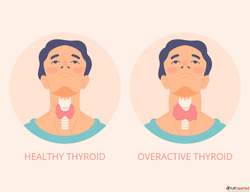 Best Homeopathic Medicine for Thyroid Disorders and Hormone ...