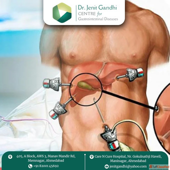 Best Gallbladder Surgeon in Ahmedabad India for Laparoscopic Care