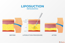 Liposuction Price in Hyderabad