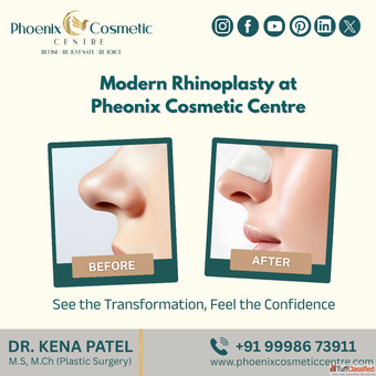 Get Best Rhinoplasty in Ahmedabad - Phoenix Cosmetic