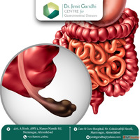 Appendix Surgeon in Ahmedabad for Planned Surgery - Dr. Jeni...