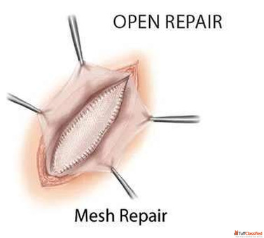 Dr. Vishal Soni -Best Hernia Surgeon in Ahmedabad for Advanced Care