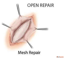 Dr. Vishal Soni -Best Hernia Surgeon in Ahmedabad for Advanc...