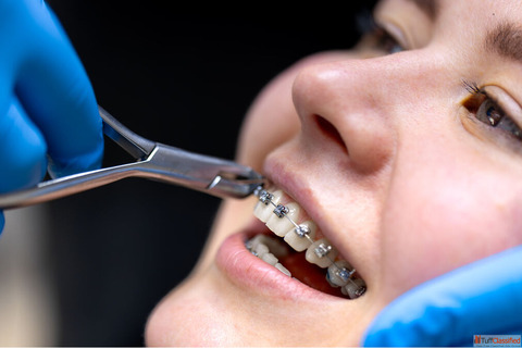 Find Best Dental Clinic for Braces Smile Correction In India - Panache Dental