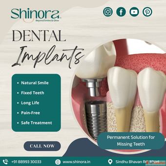 Dental Implants in Ahmedabad for Better Chewing and Natural Appearance