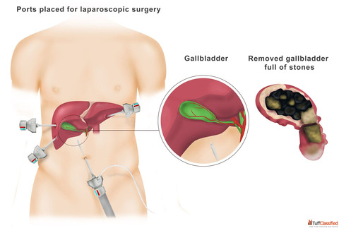 Robotic Gallbladder Surgery in Delhi - Dr. Ashish Vashistha