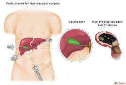 Robotic Gallbladder Surgery in Delhi - Dr. Ashish Vashistha