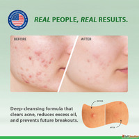 SOS Relief for Content Creators Clear Skin for HD Video