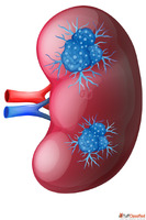 Homeopathic Treatment for Dangerous Kidney Cysts - Safe Care