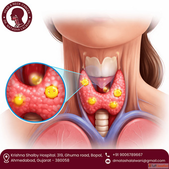 Get Expert Parathyroid Tumor Treatment in Ahmedabad - Dr. Natasha Lalwani