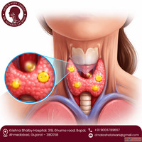 Get Expert Parathyroid Tumor Treatment in Ahmedabad - Dr. Na...