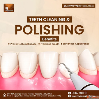Teeth Cleaning in Indirapuram