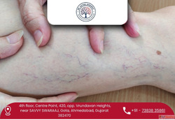 Varicose Veins Treatment in Ahmedabad by Dr.Vatsal Agrawal
