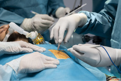 Complete Guide to Hernia Surgery in Ahmedabad - Types Treatm...