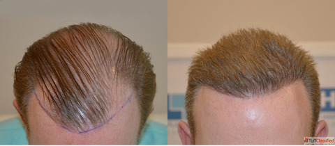 Advanced Direct Hair Implantation by DHI India