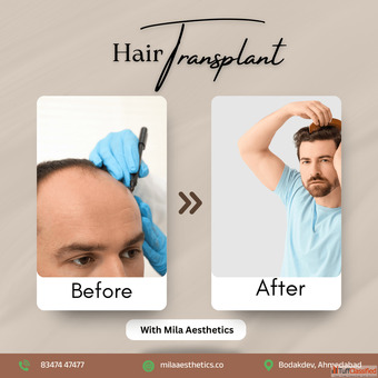 Hair Transplant in Ahmedabad - Advanced FUE DHI at Mila Aesthetics