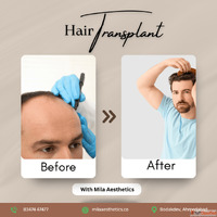 Hair Transplant in Ahmedabad - Advanced FUE DHI at Mila Aest...