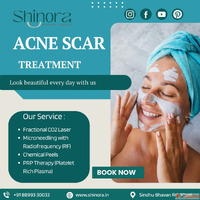 Best Acne Scar Treatment in Ahmedabad for Clear Smooth Skin ...