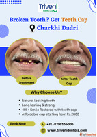 Teeth Cap Treatment in Charkhi Dadri Triveni Dental