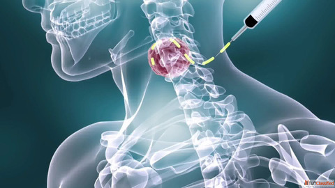 Bone Marrow Treatment for Lymphoma in Delhi