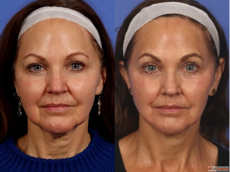 Morpheus8 Dubai - Advanced RF Microneedling for Skin Tightening Lifting