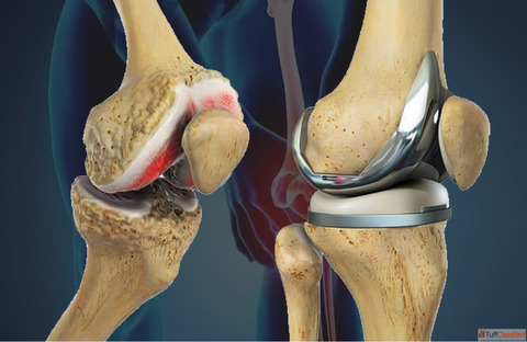 Best Knee Replacement Surgery