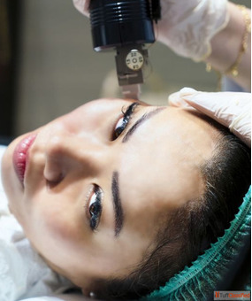 Best MNRF Treatment Acne Scar Treatment In Coimbatore