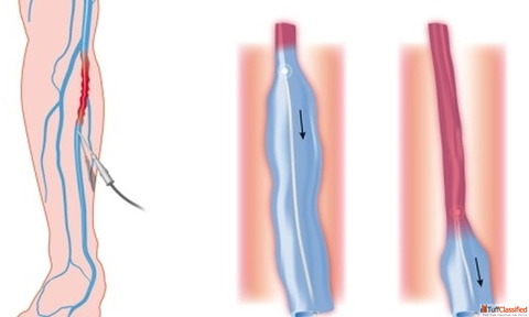 Peripheral Vascular Disease Causes Symptoms Early Diagnosis