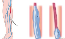 Peripheral Vascular Disease Causes Symptoms Early Diagnosis
