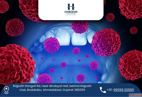 Best Oral Cancer Surgeon in Ahmedabad - Dr. Bhavin Vadodariya