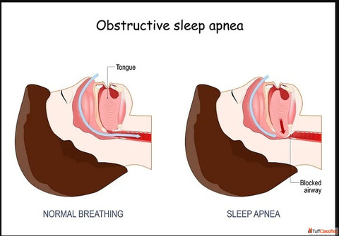 TOP Obstructive Sleep Apnea Specialist in Jaipur Rajasthan - Asthma Bhawan