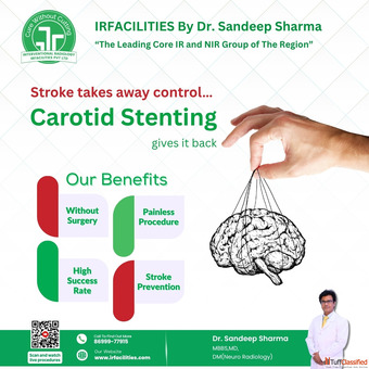 Carotid Artery Stenting Modern Vascular Care