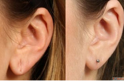 Earlobe Repair Correction Ear Hole Stitching Near Me