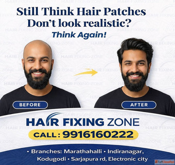 Still think hair patches don't look realistic