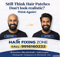 Still think hair patches don't look realistic