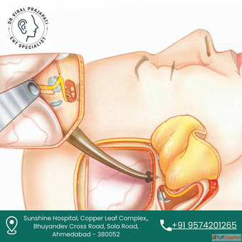 Advanced ENT Care for Facial Nerve Decompression in Ahmedabad