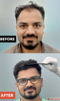 Best Hair Transplant in Ahmedabad Trusted Hair Clinic Gujarat