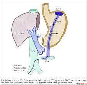Role of Portal Hypertension Radiology in Diagnosis