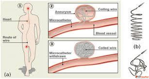 Coil Embolization Procedure is the Treatment of Brain Aneurysms