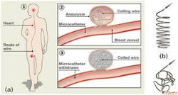Coil Embolization Procedure is the Treatment of Brain Aneury...