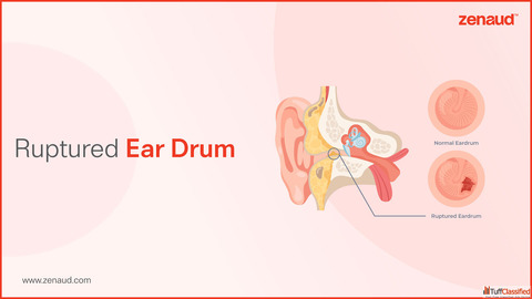 Ruptured Ear Drum - Zenaud