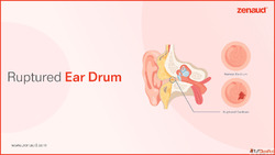 Ruptured Ear Drum - Zenaud
