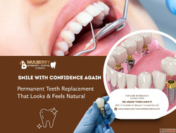Full-mouth Dental Implants in Hyderabad
