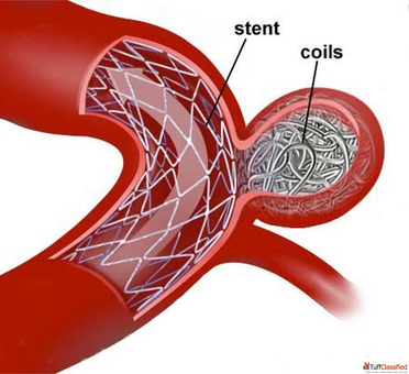 Aneurysm Coiling Treatment - Minimally Invasive Brain Aneurysm Care