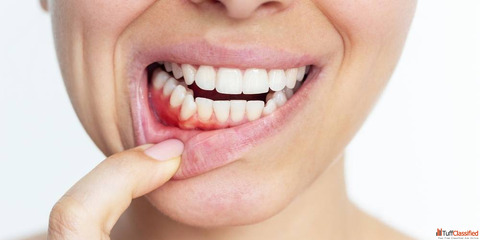 Gum Infection Treatment in Indiranagar Bangalore - House of Smiles